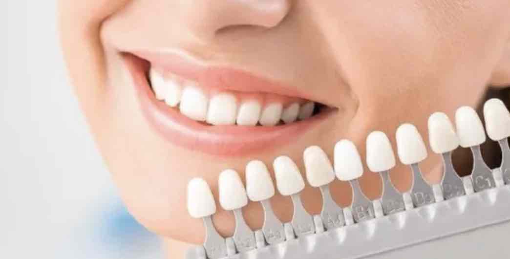 Radiant Confidence: Exploring The Importance Of Teeth Whitening In Lane Cove