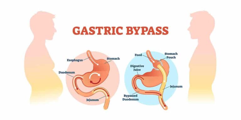 Gastric Bypass Surgery in Turkey