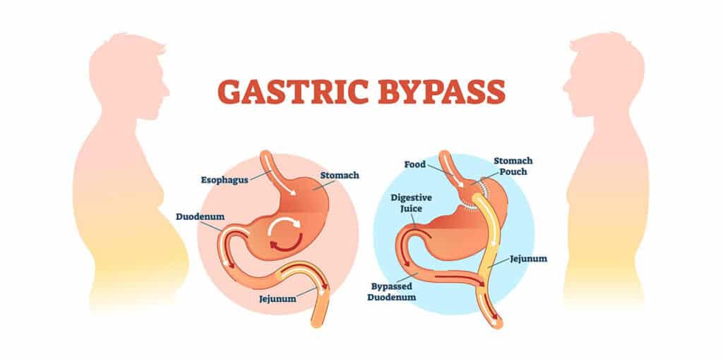Gastric Bypass Surgery in Turkey